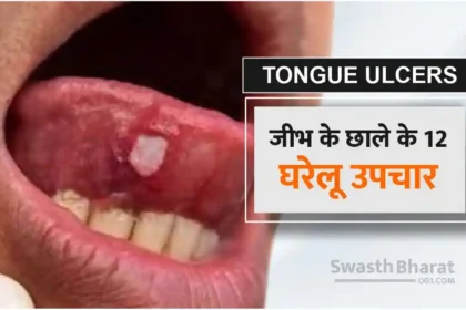 12 Home Remedies for Tongue Ulcers