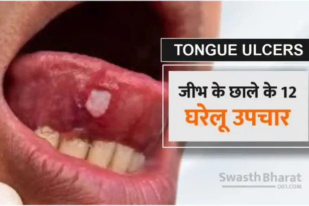 12 Home Remedies for Tongue Ulcers